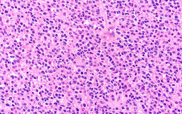 1B3 Oligodendroglioma, anaplastic Grade 3 (Case 1) H&E 40X