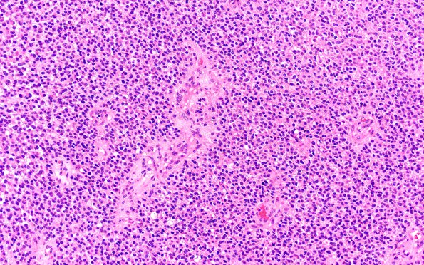 1B4 Oligodendroglioma, anaplastic Grade 3 (Case 1) H&E 20X 2