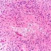 1B5 Oligodendroglioma, anaplastic Grade 3 (Case 1) B7 H&E 20X 3