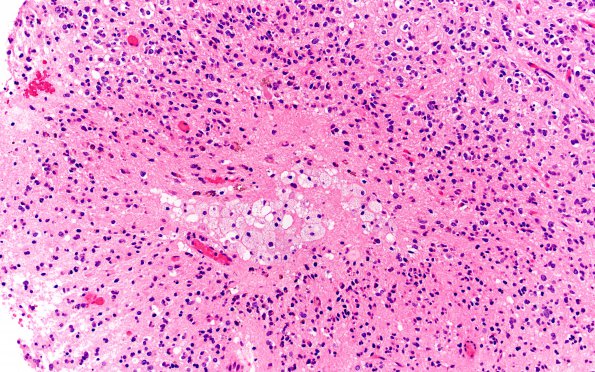 1B5 Oligodendroglioma, anaplastic Grade 3 (Case 1) B7 H&E 20X 3