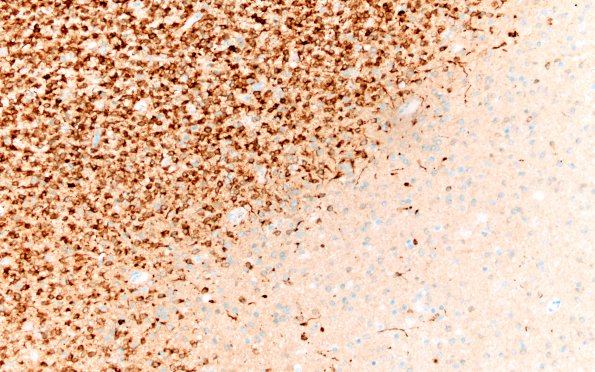 1C2 Oligodendroglioma, anaplastic Grade 3 (Case 1) IDH1 20X