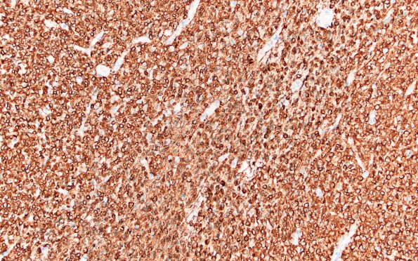 1D1 Oligodendroglioma, anaplastic Grade 3 (Case 1) GFAP 20X