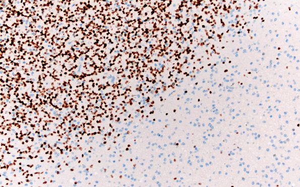 1E2 Oligodendroglioma, anaplastic Grade 3 (Case 1) Olig2 20X