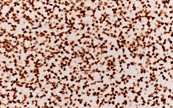 1F2 Oligodendroglioma, anaplastic Grade 3 (Case 1) ATRX 40X