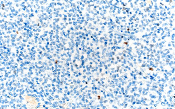 1G2 Oligodendroglioma, anaplastic Grade 3 (Case 1) P53 40X