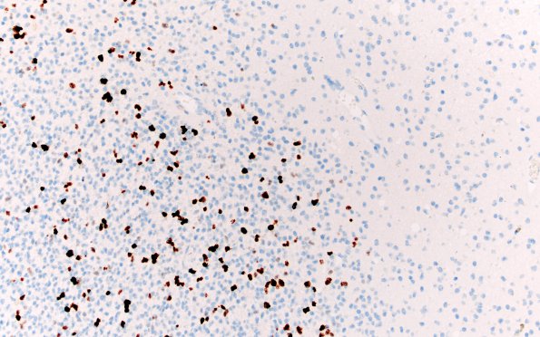 1H2 Oligodendroglioma, anaplastic Grade 3 (Case 1) Ki67 20X