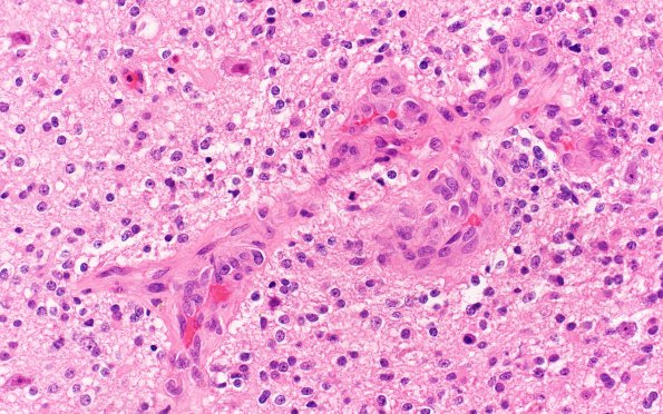 20A2 Oligodendroglioma, anaplastic Grade 3 (Case 20) H&E 40X 1