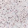 20C Oligodendroglioma, anaplastic Grade 3 (Case 20) Ki67 20X 1