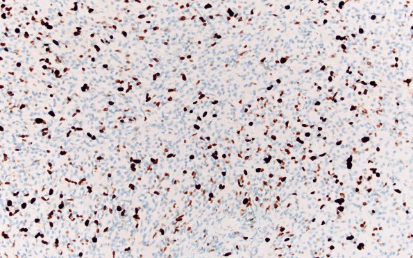 20C Oligodendroglioma, anaplastic Grade 3 (Case 20) Ki67 20X 1