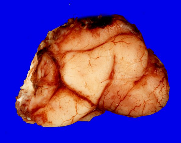 21A1 Oligodendroglioma, focal anaplasia (Case 21) gross 2