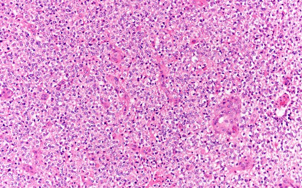 22A2 Oligodendroglioma Grade 2 (Case 22) H&E 20X 3