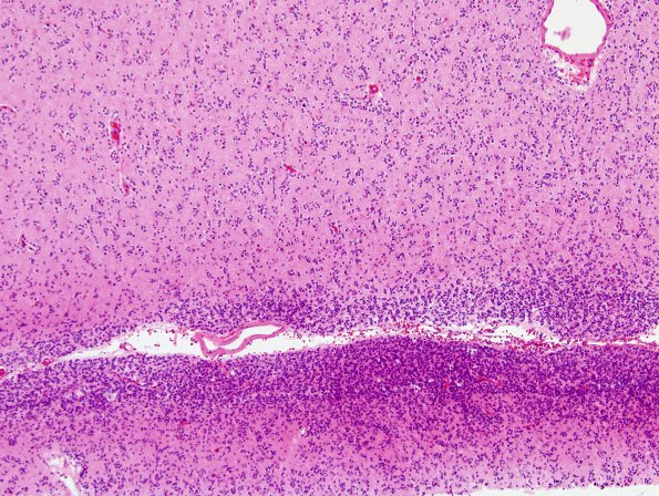 22A4 Oligodendroglioma, focal anaplastic (Case 22) H&E 10X