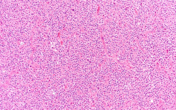 23A1 Oligodendroglioma Grade 3 (Case 23) H&E 40X 3