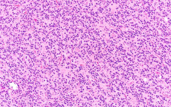 23A2 Oligodendroglioma Grade 3 (NP22-925) H&E 20X 1