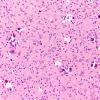 23A3 Oligodendroglioma Grade 3 (NP22-925) H&E 20X 1A