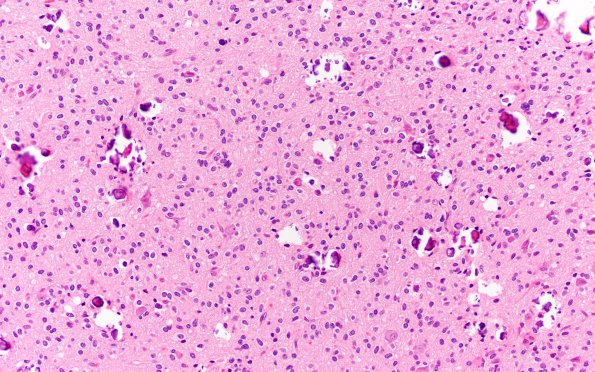 23A3 Oligodendroglioma Grade 3 (NP22-925) H&E 20X 1A