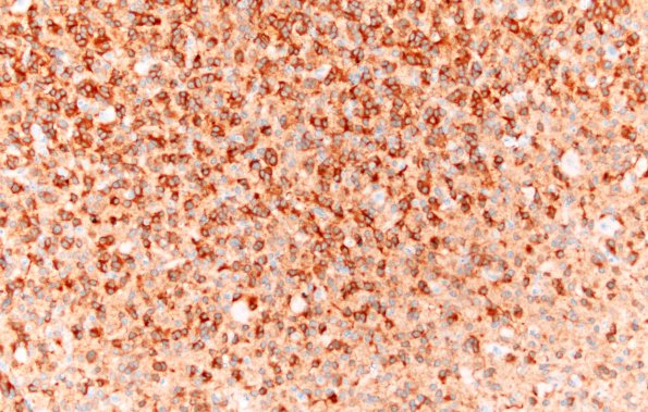 23B Oligodendroglioma, anaplastic Grade 3 (Case 23) IDH1 20X 2