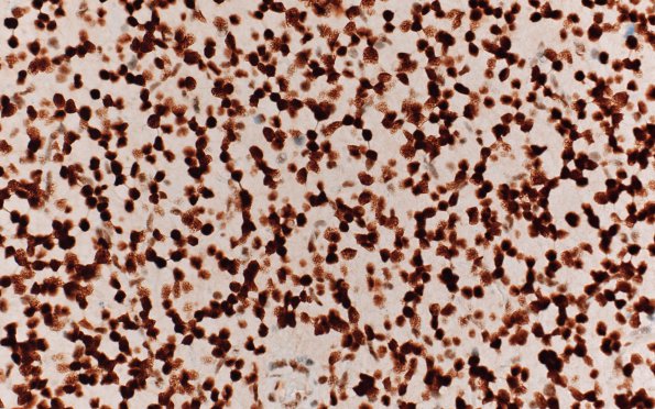 23D1 Oligodendroglioma, anaplastic Grade 3 (Case 23) ATRX 40X 2