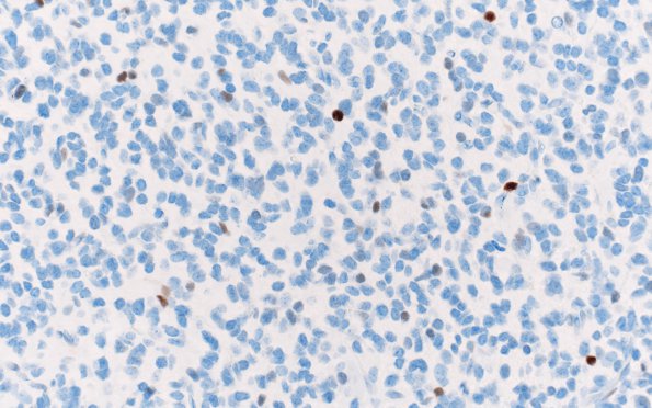 23D2 Oligodendroglioma, anaplastic Grade 3 (Case 23) P53 40X