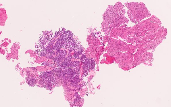 24A1 Oligodendroglioma, anaplastic Grade 3 (Case 24) H&E 4X