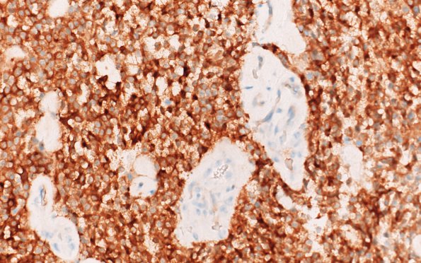 24B Oligodendroglioma, anaplastic Grade 3 (Case 24) IDH1 40X