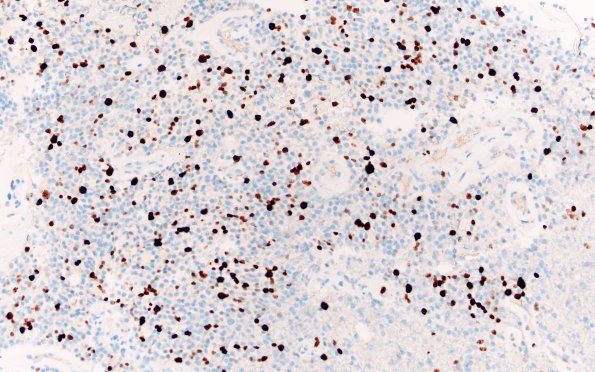 24C Oligodendroglioma, anaplastic Grade 3 (Case 24) Ki67 20X