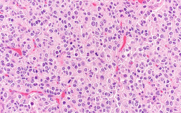 25A2 Oligodendroglioma, anaplastic Grade 3 (Case 25) 40X 2