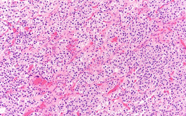 25A3 Oligodendroglioma, anaplastic Grade 3 (Case 25) 20X 1