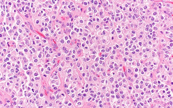 25A4 Oligodendroglioma, anaplastic Grade 3 (Case 25) 40X 3