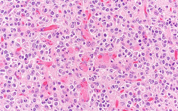 25A5 Oligodendroglioma, anaplastic Grade 3 (Case 25) 40X