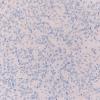 25D Oligodendroglioma, anaplastic Grade 3 (Case 25) p53 20X 1