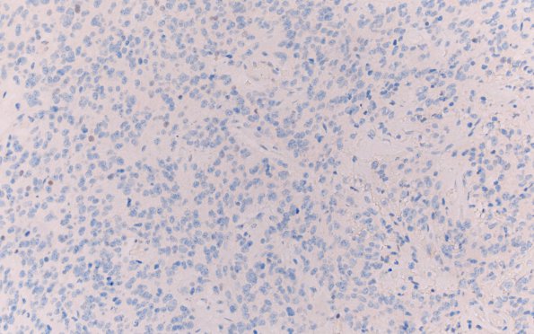 25D Oligodendroglioma, anaplastic Grade 3 (Case 25) p53 20X 1