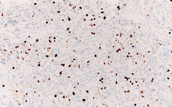 25E Oligodendroglioma, anaplastic Grade 3 (Case 25) Ki67 20X 1