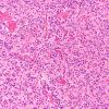 26A Oligodendroglioma, anaplastic Grade 3 (Case 26) H&E 20X