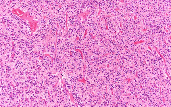 26A Oligodendroglioma, anaplastic Grade 3 (Case 26) H&E 20X