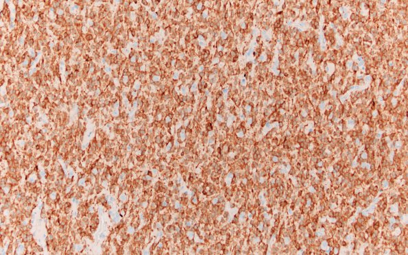 26B Oligodendroglioma, anaplastic Grade 3 (Case 26) IDH1 20X