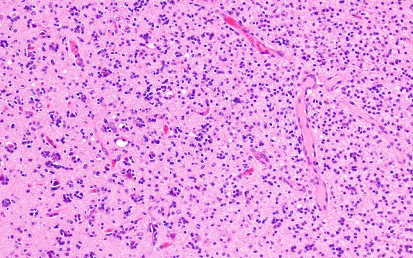 27A Oligodendroglioma, IDH mut, 1p19del Grade 3 (Case 27) H&E 4