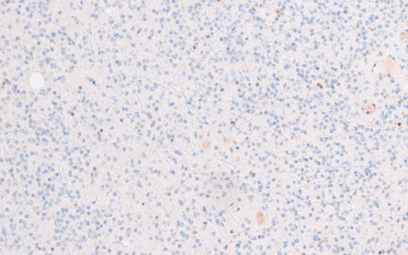 27D Oligodendroglioma, IDH mut, 1p19del Grade 3 (Case 27) p53 20X