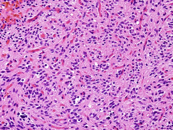 28A1 Oligodendroglioma, WHO III (Case 28) 1.jpg