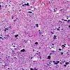 28A2 Oligodendroglioma, WHO III (Case 28) 2.jpg