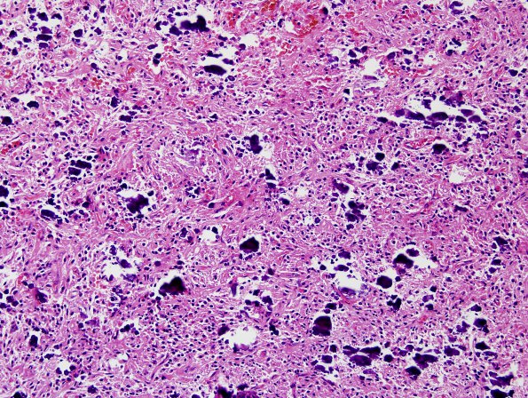 28A2 Oligodendroglioma, WHO III (Case 28) 2.jpg