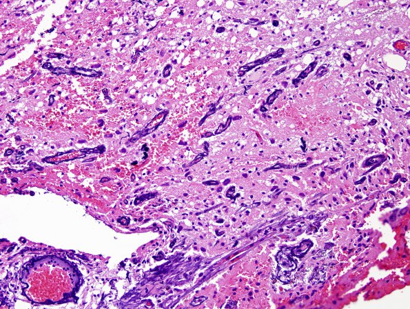 28A3 Oligodendroglioma, WHO III (Case 28) 3.jpg