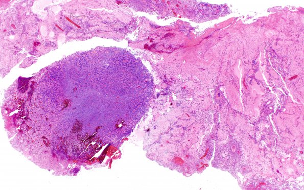 2A1 Oligodendroglioma, Anaplastic Grade 3 (Case 2) H&E 2X