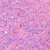 2A2 Oligodendroglioma, Anaplastic Grade 3 (Case 2) H&E 1 (2)