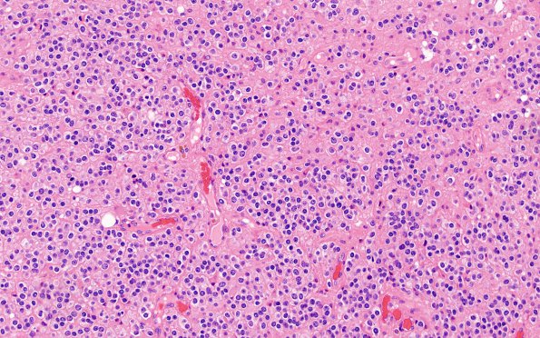 2A2 Oligodendroglioma, Anaplastic Grade 3 (Case 2) H&E 1 (2)