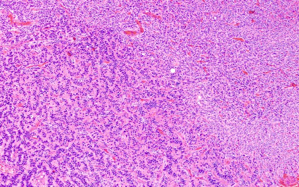 2A3 Oligodendroglioma, Anaplastic Grade 3 (Case 2) H&E 3