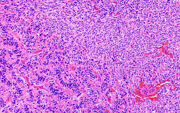 2A4 Oligodendroglioma, Anaplastic Grade 3 (Case 2) H&E 2