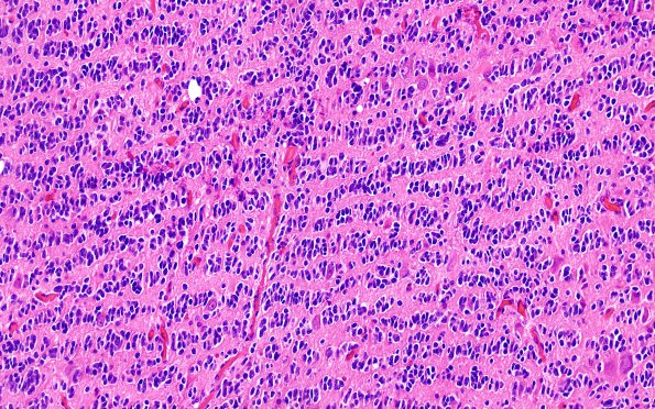 2A5 Oligodendroglioma, Anaplastic Grade 3 (Case 2) H&E 8