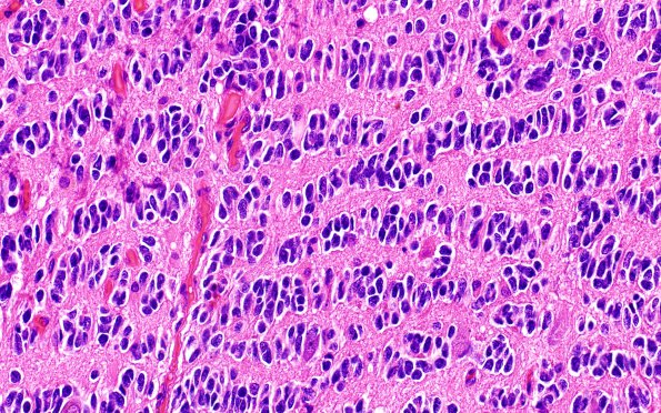 2A6 Oligodendroglioma, Anaplastic Grade 3 (Case 2) H&E 9