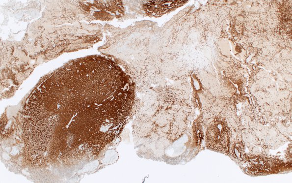 2B1 Oligodendroglioma, Anaplastic Grade 3 (Case 2) IDH1 R132H 2X